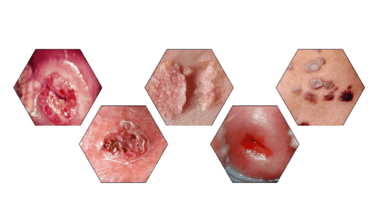 Dlaczego brodawczaki są niebezpieczne
