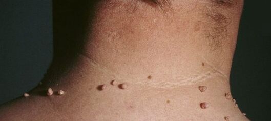 jak pozbyć się brodawczaków