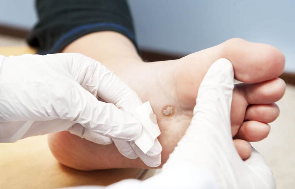 dlaczego na ciele pojawiają się brodawki