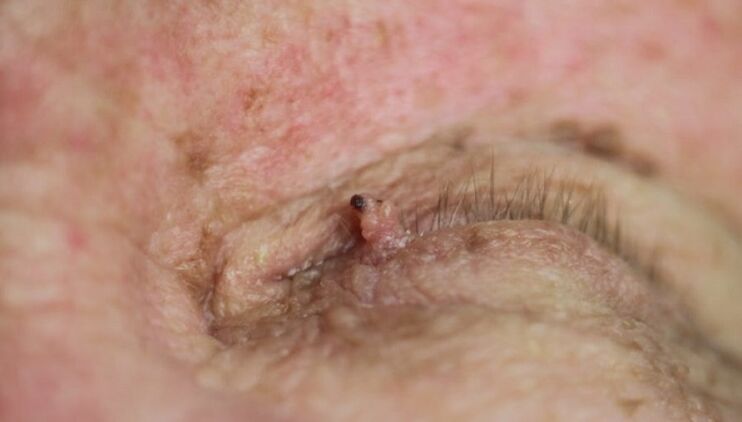 brodawczak na powiece jak się go pozbyć